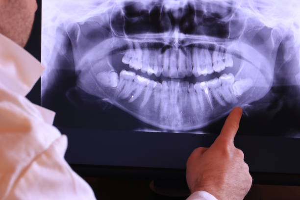 Best Knocked-Out Tooth (Avulsed Tooth) Treatment in Crystal City, TX
